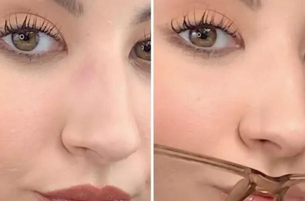 Glasses Leaving Marks on Nose Glasses Leaving Marks on Nose